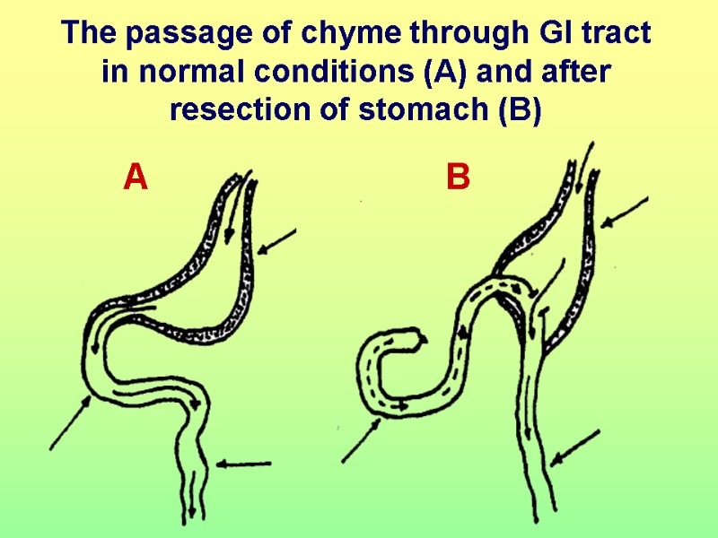 The passage of chyme through GI tract in normal conditions (A) and after resection